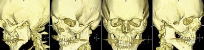 Radiology MRI: Le Fort Type 1 Fracture