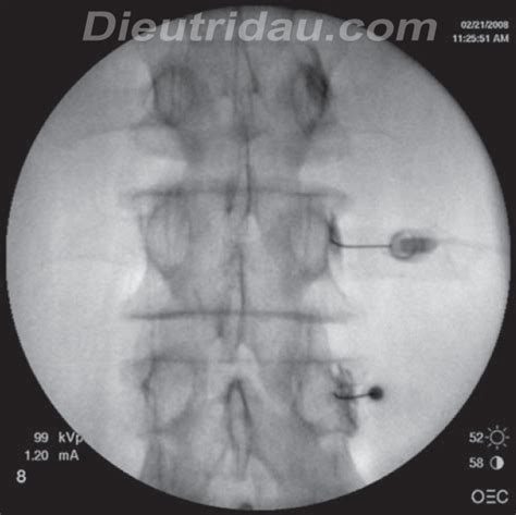 Zygapophyseal Joint Injection - Pain Management