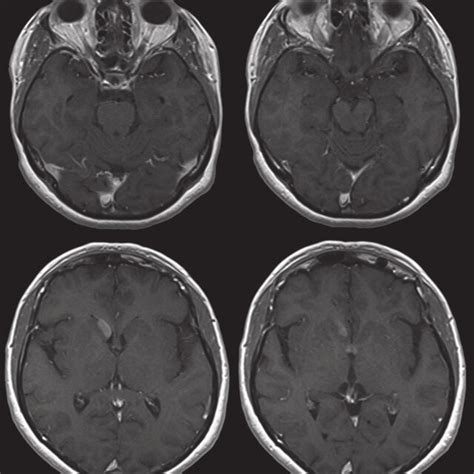 Histology of the right caudate nucleus lesion. Hematoxylin eosin with ...