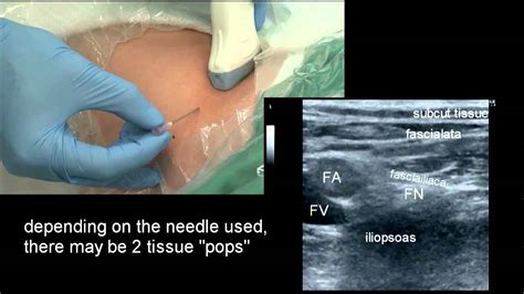 Ultrasound Guided Femoral Nerve Block In Plane Technique