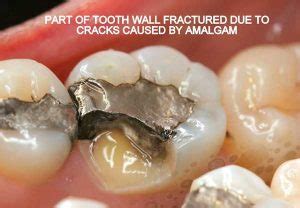 Safe Amalgam Removal Holistic Dentistry Sarkissian DDS