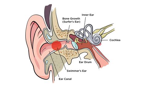 Swimmers Ear Symptoms Causes And Solution Surfears