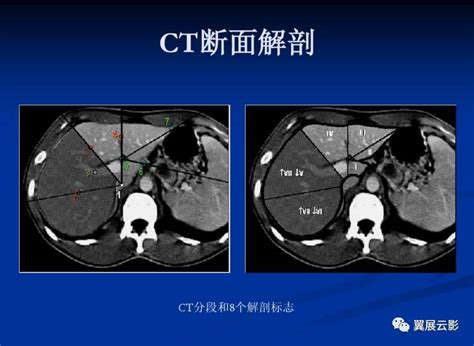 正常肝脏ct解剖