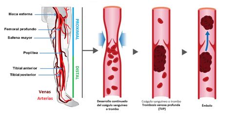 Trombosis Venosa Profunda Qu Es Causas S Ntomas Tratamiento Y