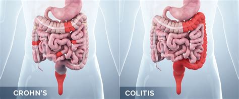 What Is The Difference Between Crohns Disease And Ulcerative Colitis Gi