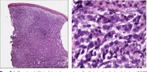 Pdf Leukemia Cutis In A Patient With Acute Myelogenous Leukemia A