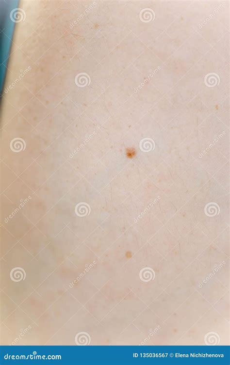 A Birthmark Or A Mole On A Woman Skin Stock Image Image Of Healthy