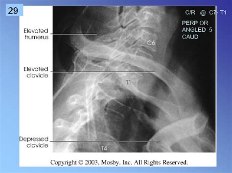 1 Cervical Spine Rtec 124 Week 6 Rev