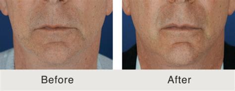 Dermal Fillers For Men Photos Charlotte NC Carolina Facial Plastics