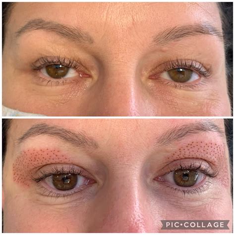 Non Surgical Plasma Eye Lift High End Treatments Bella Goode Hair