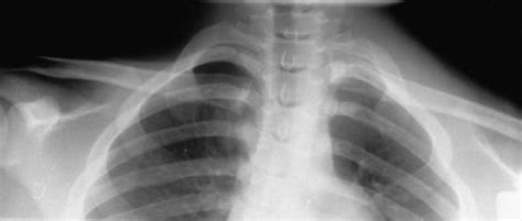 Medial Clavicle Physeal Fracture Pediatrics Orthobullets