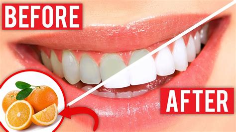 Good Food For Teeth Eat These 9 Foods For Stronger Whiter Teeth Youtube