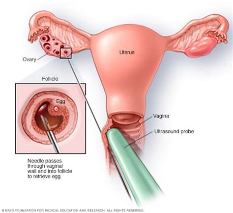 Ivf In Iran In Vitro Fertilization Treatment Ariamedtour