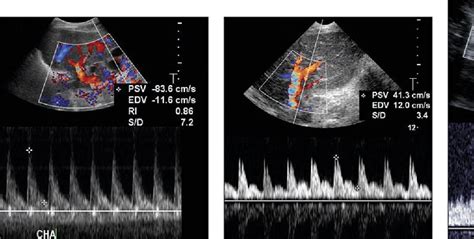 Figure 3 From Doppler Ultrasound Velocities And Resistive Indexes