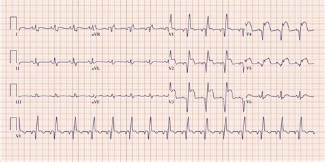 Pin On Ekg