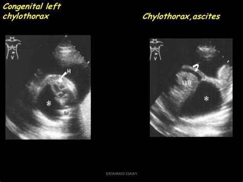 8 Fetal Chest Dr Ahmed Esawy