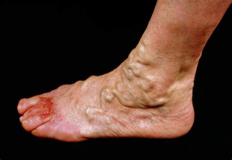 Varicose Veins On The Foot With Ulceration Of Toes Photograph By Science Photo Library