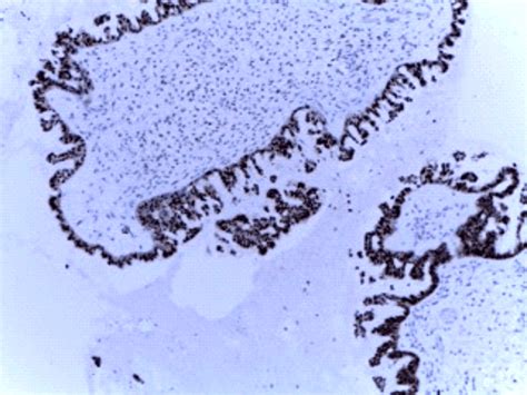 Borderline Ovarian Serous Tumor Pr Positive In About 85 Of Tumor Cells