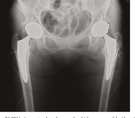 Figure 3 From Bilateral Greater Trochanteric Avulsion Fractures After