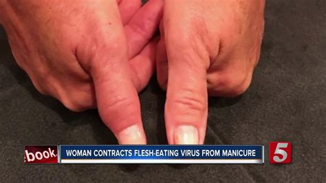 Tennessee Woman Almost Loses Her Hand Says She Contracted Flesh Eating