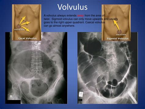 Ppt Abdominal X Ray Radiological Signs Powerpoint Presentation Free Download Id 6717699