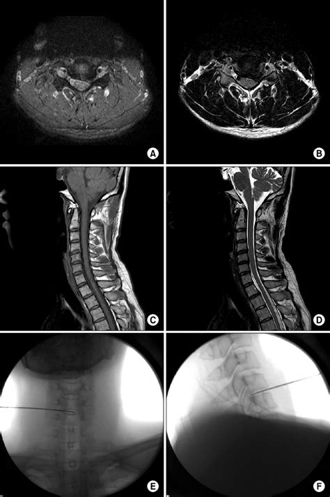 Mri Read Cervical Spine Axial View Anatomy Of Cervical Spine Axial