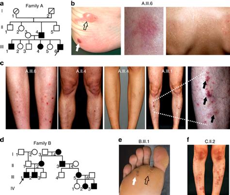 Pedigrees And Clinical Presentation Of The Patients With Epidermolysis