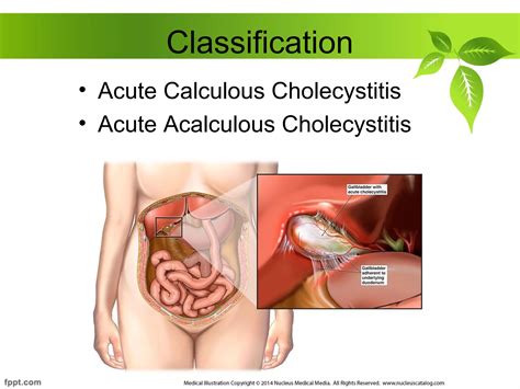 Acute And Chronic Cholecystitis Ppt