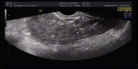 Two Cases Of Intrauterine Pregnancy With Tubal Stump Pregnan Medicine