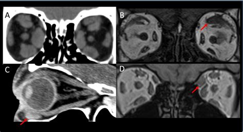 Ophthalmology Thyroid Mri