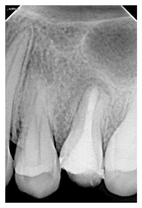 A Preoperative Radiograph Case B Working Length Radiograph