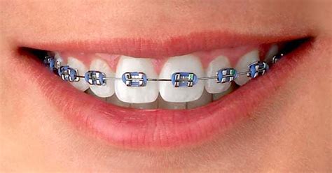 Conoce Las Diferencias Entre Los Brackets Est Ticos Y Los Met Licos