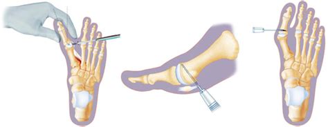 Op Ration Hallux Valgus Par Voie Mini Invasive