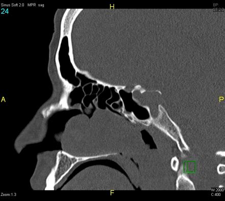 Antrochoanal Polyp Image Radiopaedia Org