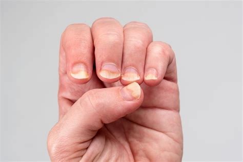 Ridges In Fingernails 5 Common Causes And What To Do Tua Saúde