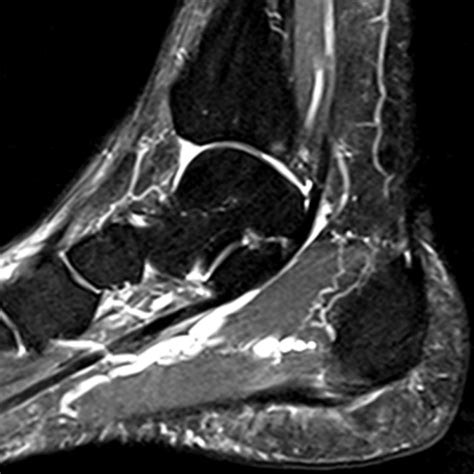 Radiologia Do Esporte Fasce Te Plantar