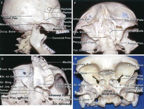 Vomer Bone Anatomy