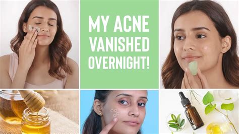 How To Get Rid Of Acne Fast Overnight Professional Advice