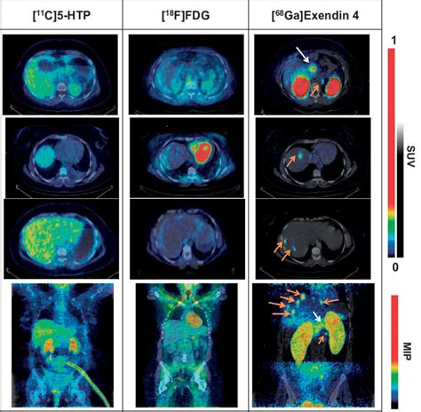 Representative Pet Ct Images Of The Insulinoma Patient With