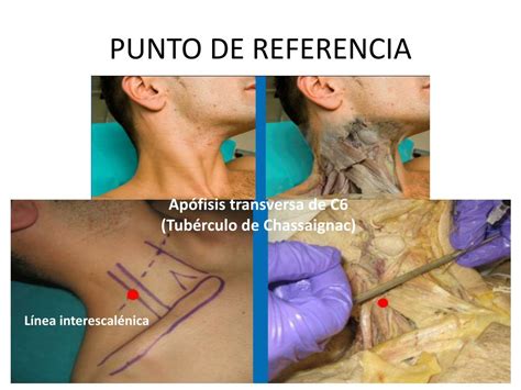 PPT BLOQUEO INTERESCALENICO SUPRACLAVICULAR E INFRACLAVICULAR DEL