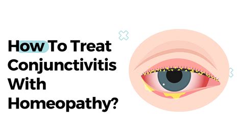 How To Treat Conjunctivitis With Homeopathy?