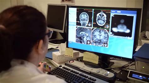 La Enfermedad De Alzheimer Progresa Más Rápido En Las Personas Con Síndrome De Down Infobae