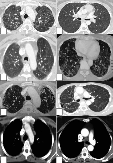 High Resolution Computed Tomography Chest Characteristics A