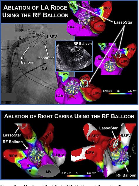 Figure From Wide Area Antral Pulmonary Vein And Posterior Wall