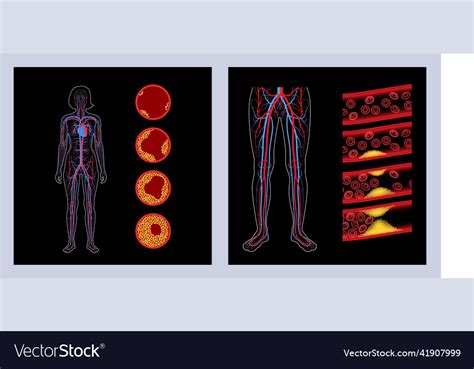 Peripheral Artery Disease Royalty Free Vector Image