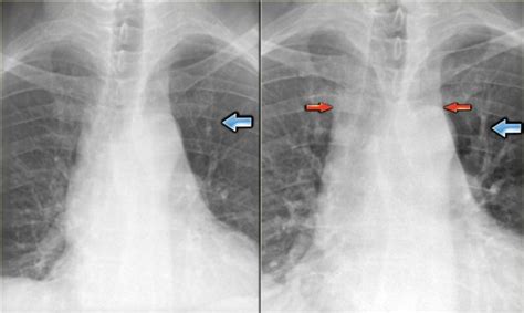 The Radiology Assistant : Chest X-Ray - Heart Failure