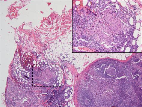 Cervical Lymph Node Metastasis Of Lymphoepithelioma Like Carcinoma Of