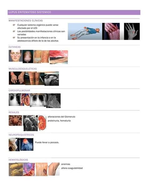 Lupus Eritematoso Sistémico y Artritis Idiopatica Juvenil daniela