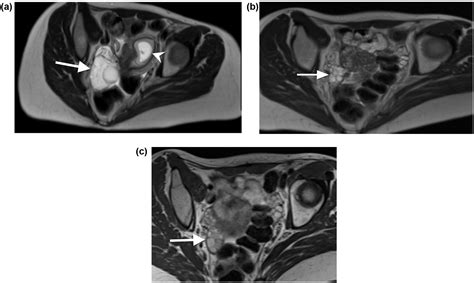 Mri Of Ovarian Torsion Correlation Of Imaging Features With The