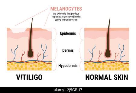 Melanocyte Structure And Anatomy Melanin Producing Cells Melanin Is